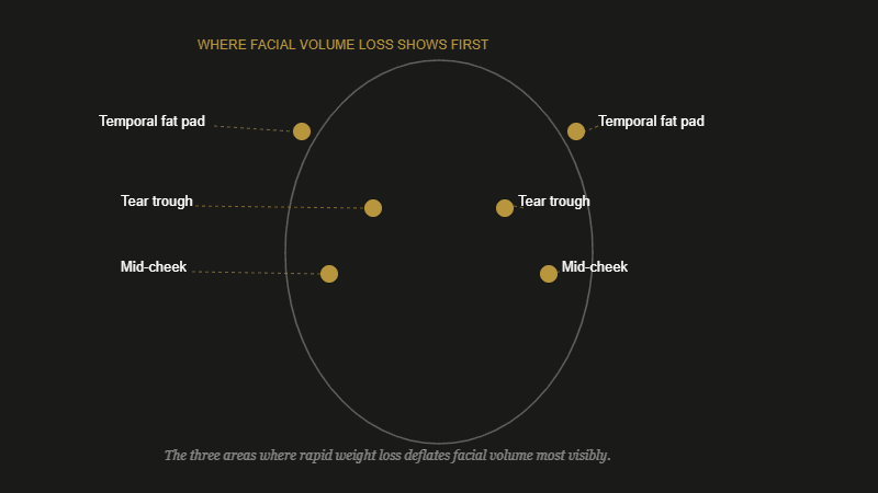 Diagram showing the three facial fat pad areas most affected by ozempic face and rapid weight loss