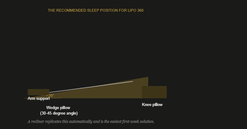 Diagram showing the ideal sleeping positions after lipo 360 with wedge pillow, knee pillow, and arm support